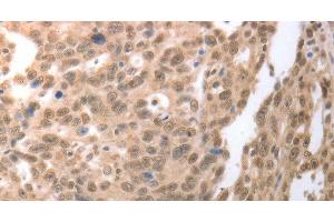 Immunohistochemistry of paraffin-embedded Human ovarian cancer tissue using RAD52 Polyclonal Antibody at dilution 1:50 (RAD52 antibody)