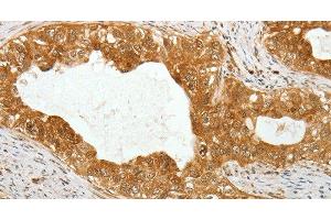 Immunohistochemistry of paraffin-embedded Human cervical cancer using TEKT1 Polyclonal Antibody at dilution of 1:30 (TEKT1 antibody)