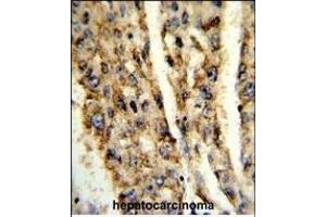 Formalin-fixed and paraffin-embedded human hepatocarcinoma reacted with DIO3 Antibody (C-term), which was peroxidase-conjugated to the secondary antibody, followed by DAB staining. (DIO3 antibody  (C-Term))