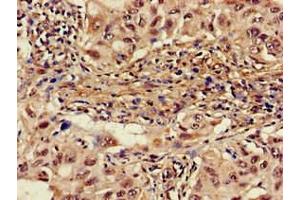 Immunohistochemistry of paraffin-embedded human lung cancer using ABIN7142600 at dilution of 1:100 (ALAS1 antibody  (AA 57-285))