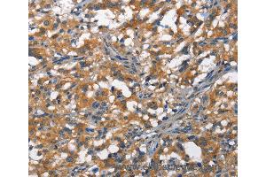 Immunohistochemistry of Human thyroid cancer using DDR2 Polyclonal Antibody at dilution of 1:40 (DDR2 antibody)