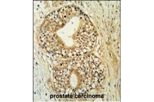 ATP11C Antibody (Center (ABIN651638 and ABIN2840341) immunohistochemistry analysis in formalin fixed and paraffin embedded human prostate carcinoma followed by peroxidase conjugation of the secondary antibody and DAB staining.