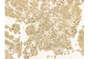 ABIN6263552 and ABIN6276984 at 1/100 staining human hepatocellular carcinoma by IHC-P. (Norrie Disease (Pseudoglioma) antibody  (Internal Region))
