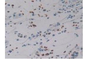 IHC-P analysis of Human Stomach Cancer Tissue, with DAB staining. (DEFA4 antibody  (AA 23-97))