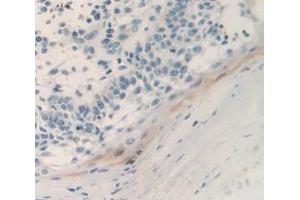 Used in DAB staining on fromalin fixed paraffin- embedded skin cancer tissue (Urocortin 2 antibody  (AA 20-112))