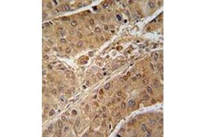Immunohistochemical staining of formalin-fixed and paraffin-embedded human hepatocarcinoma reacted with RPS6KB2 monoclonal antibody  at 1:50-1:100 dilution.