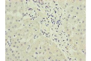 Immunohistochemistry of paraffin-embedded human liver cancer using ABIN7169283 at dilution of 1:100 (PPP2R3B antibody  (Regulatory Subunit B))