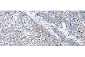 Immunohistochemistry of paraffin-embedded Human liver cancer tissue using WIF1 Polyclonal Antibody at dilution of 1:100(x200) (WIF1 antibody)