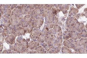 ABIN6273286 at 1/100 staining Human pancreas cancer tissue by IHC-P. (PAFAH2 antibody  (Internal Region))