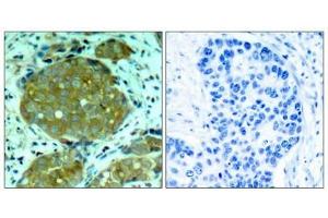 Immunohistochemical analysis of paraffin-embedded human breast carcinoma tissue using NFkB-p105(Phospho-Ser932) Antibody(left) or the same antibody preincubated with blocking peptide(right). (NFKB1 antibody  (pSer932))
