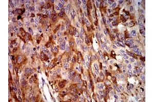 Immunohistochemical analysis of paraffin-embedded ovarian cancer tissues using C3C mouse mAb with DAB staining. (Complement C3c antibody  (AA 1521-1649))
