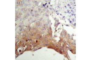 Immunohistochemical analysis of TSC2 staining in human prostate cancer formalin fixed paraffin embedded tissue section. (Tuberin antibody)