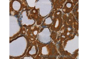 Immunohistochemistry of Human liver cancer using PARP3 Polyclonal Antibody at dilution of 1:40