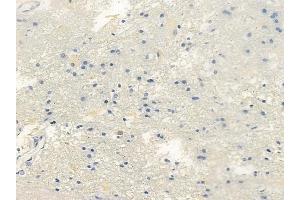 ABIN6261314 and ABIN6266687 at 1/100 staining human glioblastoma by IHC-P.