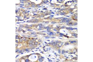 Immunohistochemistry of paraffin-embedded human gastric cancer using HAPLN1 antibody.