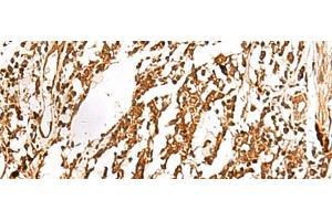 Immunohistochemistry of paraffin-embedded Human lung cancer tissue using TERF1 Polyclonal Antibody at dilution of 1:30(x200)