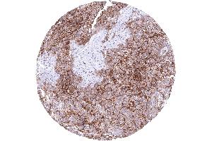 Lung Malignant mesothelioma with strong CD141 immunostaining of tumor cells CD141 immunohistochemistry.