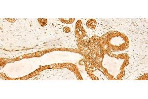 Immunohistochemistry of paraffin-embedded Human ovarian cancer tissue using KRT76 Polyclonal Antibody at dilution of 1:50(x200) (Cytokeratin 2 antibody)