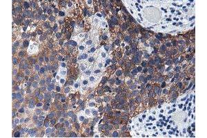 Immunohistochemical staining of paraffin-embedded Carcinoma of Human kidney tissue using anti-ALDH1L1 mouse monoclonal antibody. (ALDH1L1 antibody)
