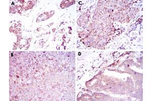 Immunohistochemical analysis of paraffin-embedded human breast cancer tissue (A), tonsil tissue (B), kidney cancer tissue (C) and stomach cancer tissue (D) using BMPR2 monoclonal antibody, clone 1F12  with DAB staining.