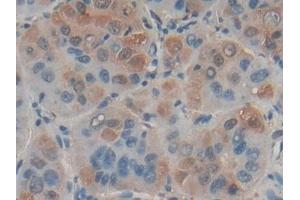 Detection of FASL in Human Liver cancer Tissue using Polyclonal Antibody to Factor Related Apoptosis Ligand (FASL) (FASL antibody)