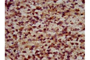 IHC image of ABIN7150380 diluted at 1:600 and staining in paraffin-embedded human glioma performed on a Leica BondTM system. (RFX2 antibody  (AA 1-130))