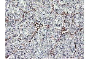 Immunohistochemical staining of paraffin-embedded Carcinoma of Human liver tissue using anti-MIER2 mouse monoclonal antibody.