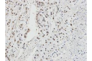 IHC-P Image Immunohistochemical analysis of paraffin-embedded A549 xenograft, using RPA32/RPA2, antibody at 1:100 dilution. (RPA2 antibody)