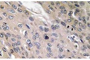 Immunohistochemistry (IHC) analyzes of BMP-6 antibody in paraffin-embedded human lung carcinoma tissue. (BMP6 antibody)