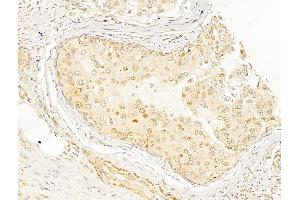 ABIN6255153 and ABIN6267596 at 1/100 staining Human breast cancer by IHC-P. (NF-kB p65 antibody  (pSer276))