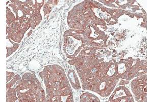 IHC-P Image Immunohistochemical analysis of paraffin-embedded gastric cancer N87 xenograft, using NOV, antibody at 1:100 dilution. (NOV antibody  (Center))