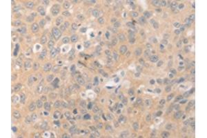 The image on the left is immunohistochemistry of paraffin-embedded Human ovarian cancer tissue using ABIN7189978(BEST1 Antibody) at dilution 1/20, on the right is treated with synthetic peptide. (Bestrophin 1 antibody)