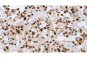 Immunohistochemistry of paraffin-embedded Human thyroid cancer using IL17C Polyclonal Antibody at dilution of 1:50 (IL17C antibody)