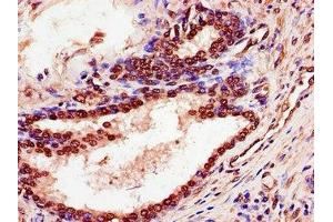 Immunohistochemistry of paraffin-embedded human prostate cancer using ABIN7168587 at dilution of 1:100 (SPDEF/PSE antibody  (AA 145-247))