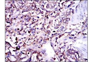 Immunohistochemical analysis of paraffin-embedded stomach cancer tissues using G6PD mouse mAb with DAB staining.