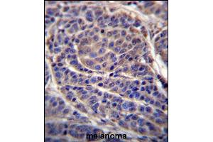 CA6 Antibody (C-term) (ABIN656592 and ABIN2845853) immunohistochemistry analysis in formalin fixed and paraffin embedded human melanoma followed by peroxidase conjugation of the secondary antibody and DAB staining. (CA6 antibody  (C-Term))