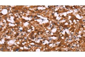 Immunohistochemistry of paraffin-embedded Human thyroid cancer using BRK1 Polyclonal Antibody at dilution of 1:40