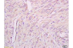 Formalin-fixed and paraffin embedded human cervical carcinoma tissue labeled with Anti phospho-IFNAR1(Ser535+Ser539) Polyclonal Antibody,Unconjugated (ABIN802353) at 1:200 followed by conjugation to the secondary antibody and DAB staining. (IFNAR1 antibody  (pSer535, pSer538))