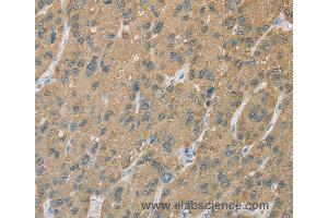 Immunohistochemistry of Human gastric cancer using CYP2C9 Polyclonal Antibody at dilution of 1:50 (CYP2C9 antibody)