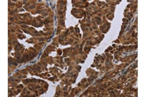The image on the left is immunohistochemistry of paraffin-embedded Human ovarian cancer tissue using ABIN7191351(MAGEB3 Antibody) at dilution 1/20, on the right is treated with synthetic peptide. (MAGEB3 antibody)