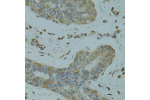 Immunohistochemistry of paraffin-embedded human breast cancer using DGKQ antibody (ABIN1872259) at dilution of 1:100 (40x lens). (DGKQ antibody)