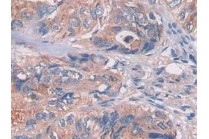 DAB staining on IHC-P; Samples: Human Colorectal cancer Tissue (LGALS3BP antibody  (AA 24-221))