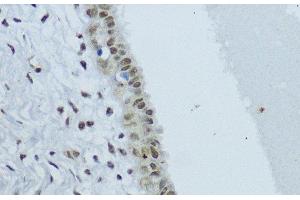 Immunohistochemistry of paraffin-embedded Human mammary cancer using NR1I3 Polyclonal Antibody at dilution of 1:200 (40x lens).