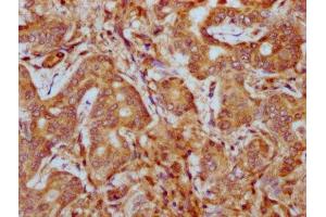 IHC image of ABIN7163100 diluted at 1:400 and staining in paraffin-embedded human liver cancer performed on a Leica BondTM system. (PHACTR1 antibody  (AA 263-387))
