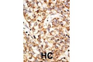 Formalin-fixed and paraffin-embedded human cancer tissue reacted with the primary antibody, which was peroxidase-conjugated to the secondary antibody, followed by DAB staining. (APOBEC1 antibody  (N-Term))