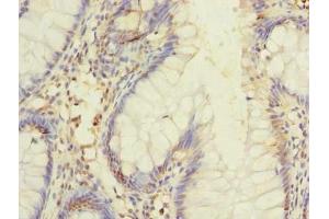 Immunohistochemistry of paraffin-embedded human colon cancer using ABIN7150013 at dilution of 1:100 (DIS3L antibody  (AA 1-300))