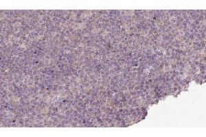 ABIN6273149 at 1/100 staining Human lymph cancer tissue by IHC-P.