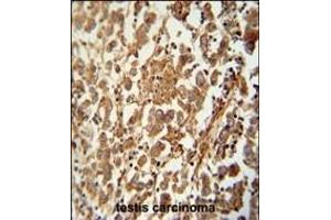 STC1 antibody (N-term) (ABIN654579 and ABIN2844281) immunohistochemistry analysis in formalin fixed and raffin embedded human testis carcinoma followed by peroxidase conjugation of the secondary antibody and DAB staining. (SPATC1 antibody  (N-Term))