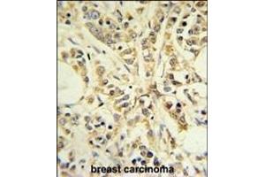 RPS13 Antibody (Center) (ABIN650998 and ABIN2840031) IHC analysis in formalin fixed and paraffin embedded breast carcinoma followed by peroxidase conjugation of the secondary antibody and DAB staining. (RPS13 antibody  (AA 82-110))