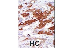 Formalin-fixed and paraffin-embedded human cancer tissue reacted with the primary antibody, which was peroxidase-conjugated to the secondary antibody, followed by DAB staining. (SGK3 antibody  (N-Term))